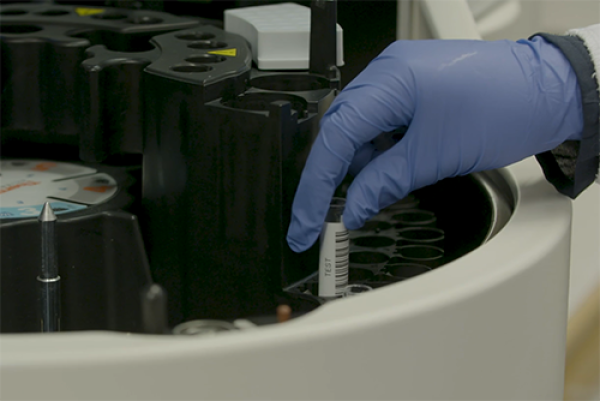 AI system effective in diagnosing prostate cancer